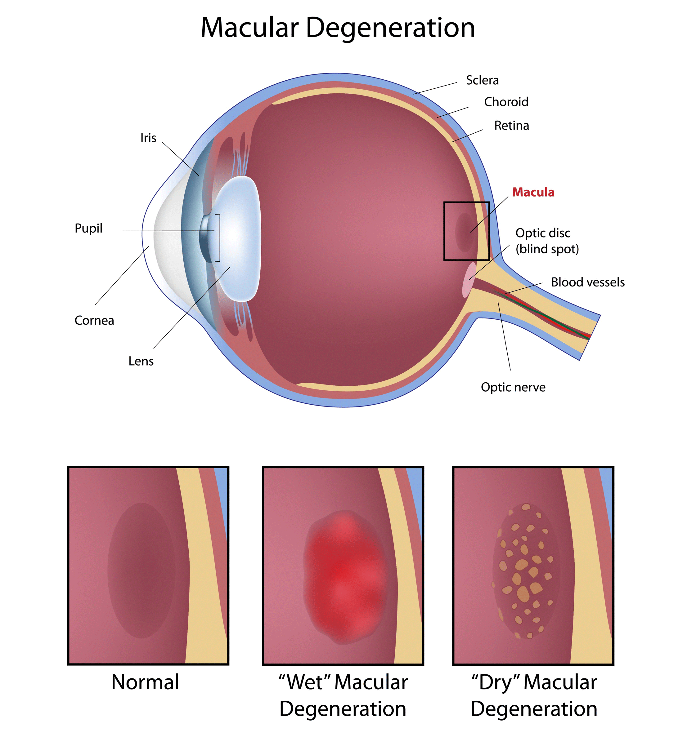 Figure 5: Aged-Related Macular Degeneration