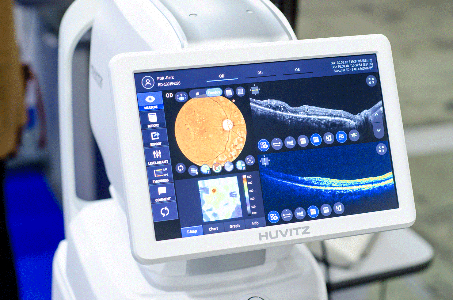 Figure 4: OCT retinal images